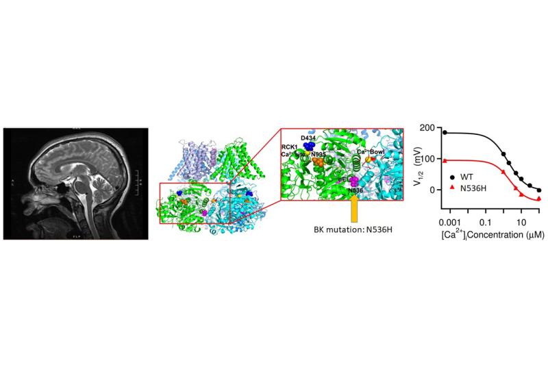 Human BK channel mutation associated with dystonia