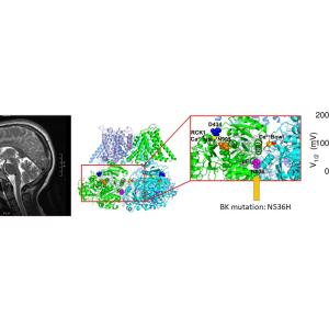 Human BK channel mutation associated with dystonia